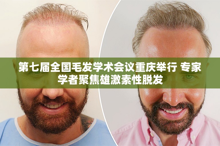 第七届全国毛发学术会议重庆举行 专家学者聚焦雄激素性脱发