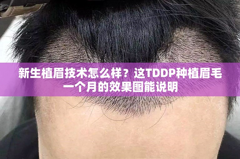 新生植眉技术怎么样？这TDDP种植眉毛一个月的效果图能说明