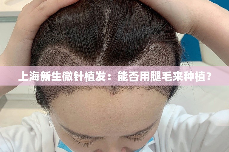 上海新生微针植发：能否用腿毛来种植？