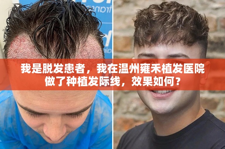 我是脱发患者，我在温州雍禾植发医院做了种植发际线，效果如何？