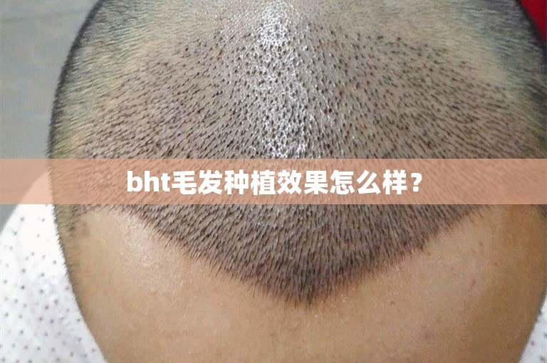 bht毛发种植效果怎么样？