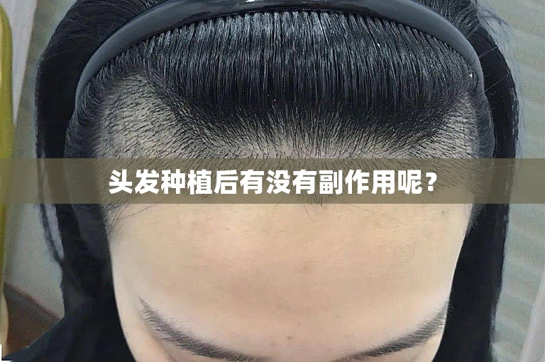 头发种植后有没有副作用呢？