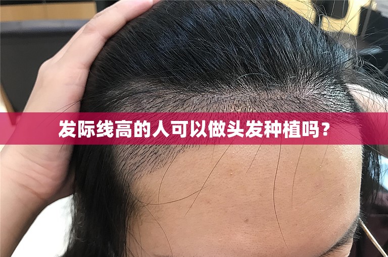 发际线高的人可以做头发种植吗？