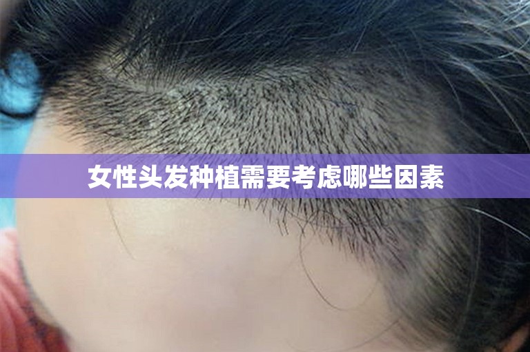 女性头发种植需要考虑哪些因素