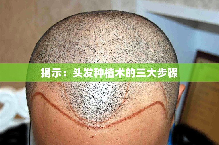 揭示：头发种植术的三大步骤