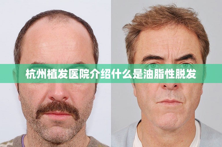 杭州植发医院介绍什么是油脂性脱发