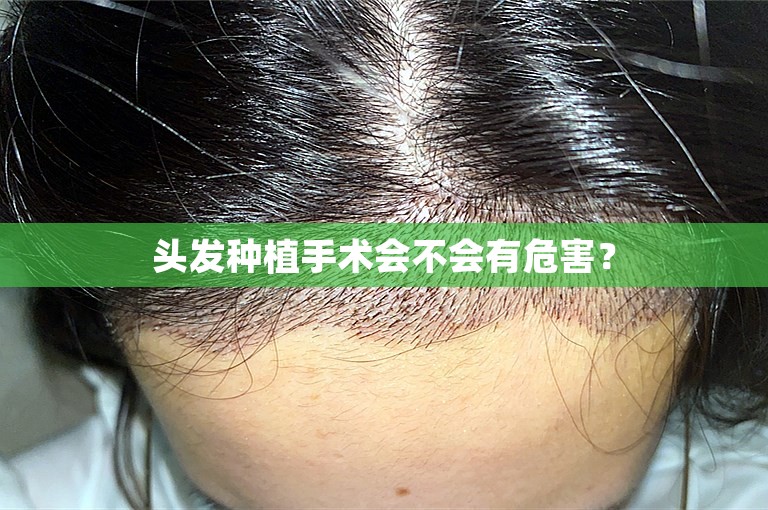 头发种植手术会不会有危害？
