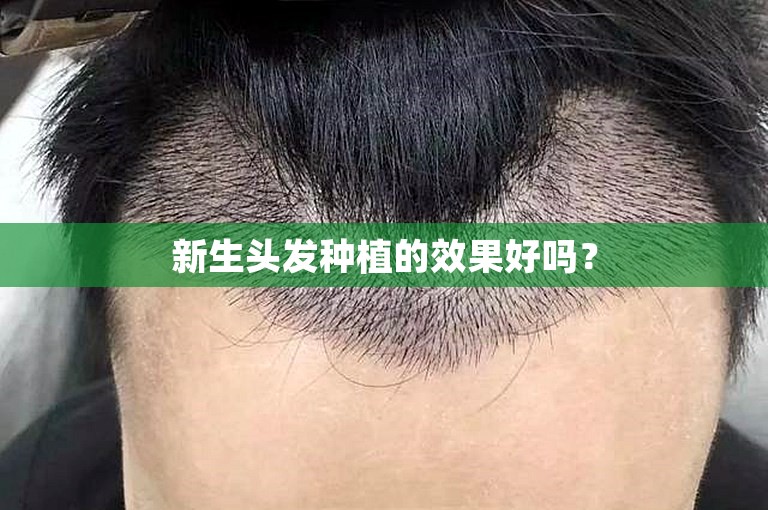 新生头发种植的效果好吗？