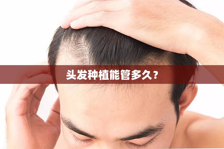 头发种植能管多久？