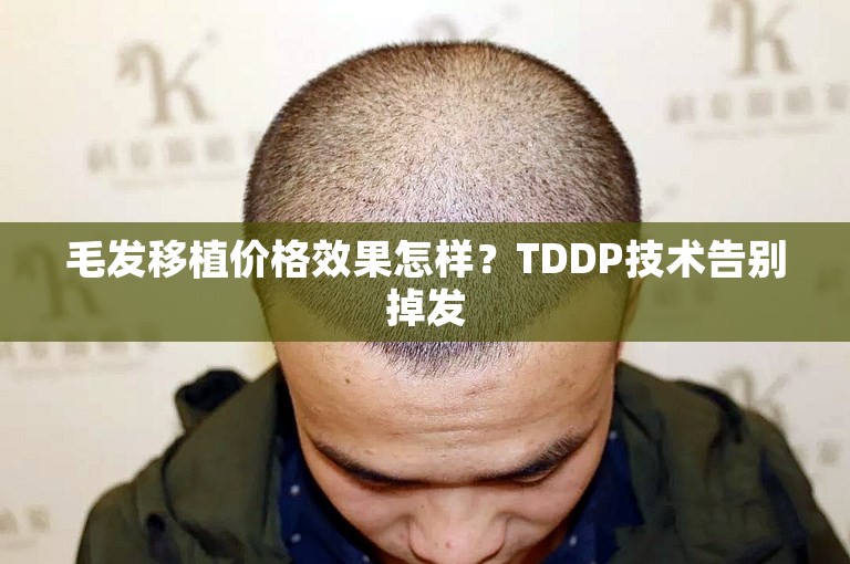 毛发移植价格效果怎样？TDDP技术告别掉发