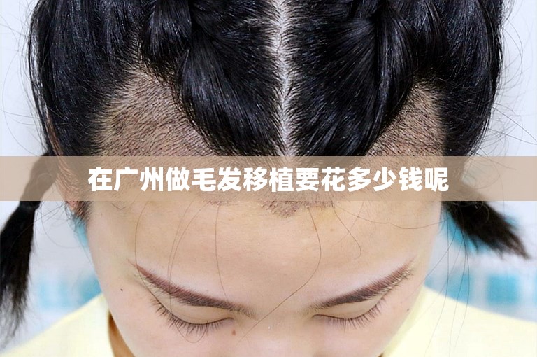 在广州做毛发移植要花多少钱呢