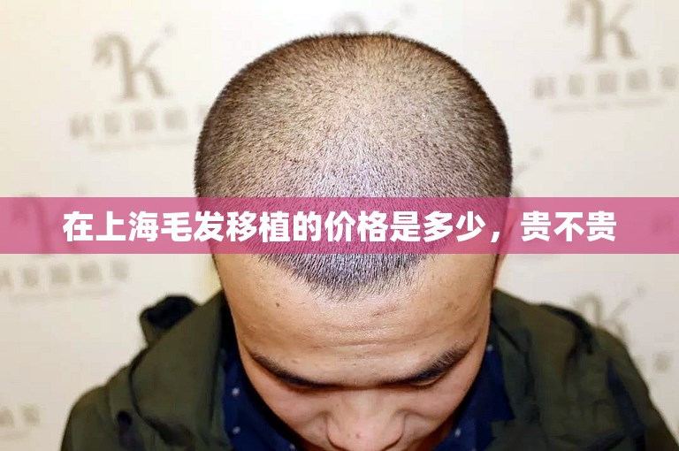 在上海毛发移植的价格是多少，贵不贵