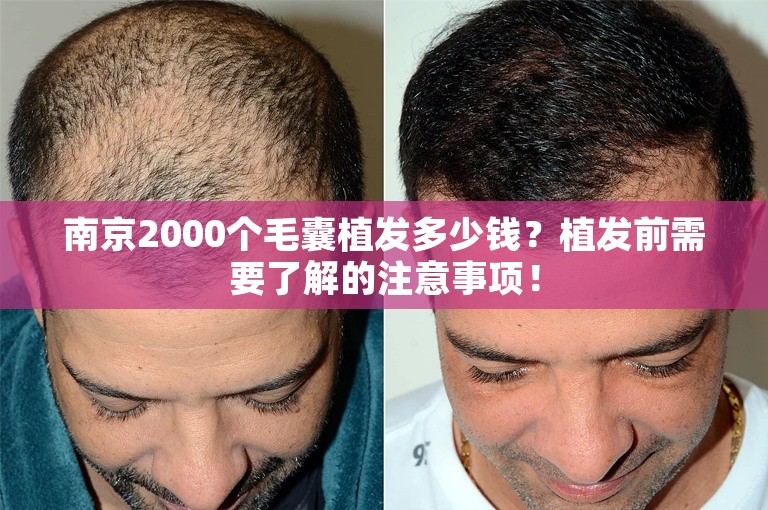 南京2000个毛囊植发多少钱？植发前需要了解的注意事项！