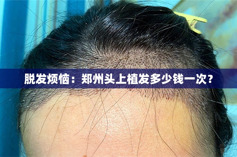 脱发烦恼：郑州头上植发多少钱一次？
