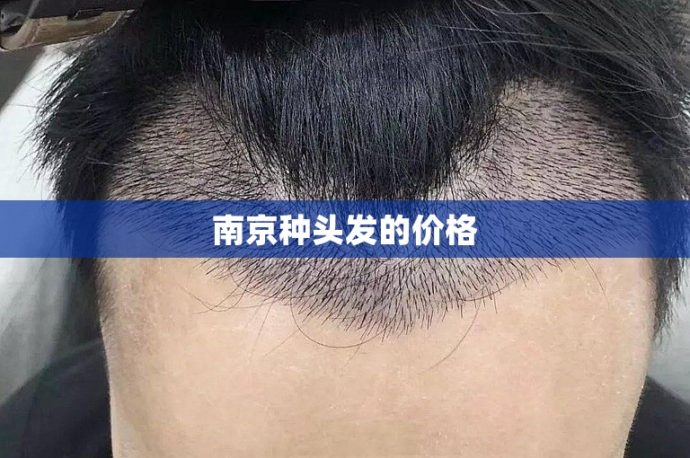 南京种头发的价格