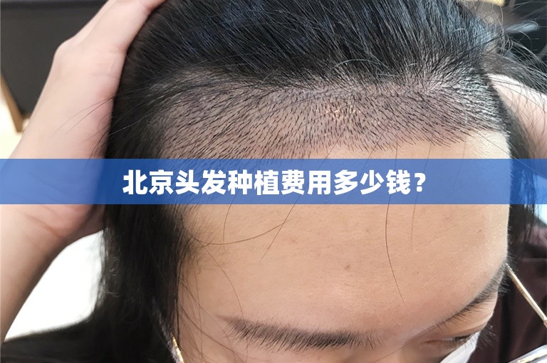 北京头发种植费用多少钱？