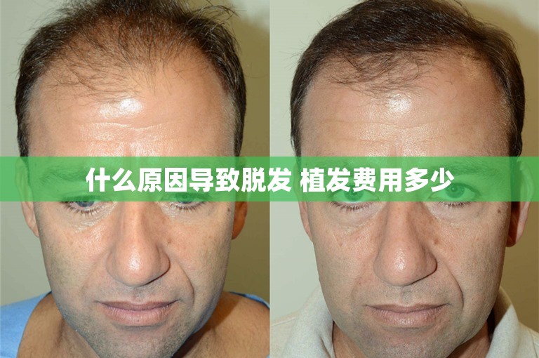 什么原因导致脱发 植发费用多少 什么原因导致脱发 植发费用多少