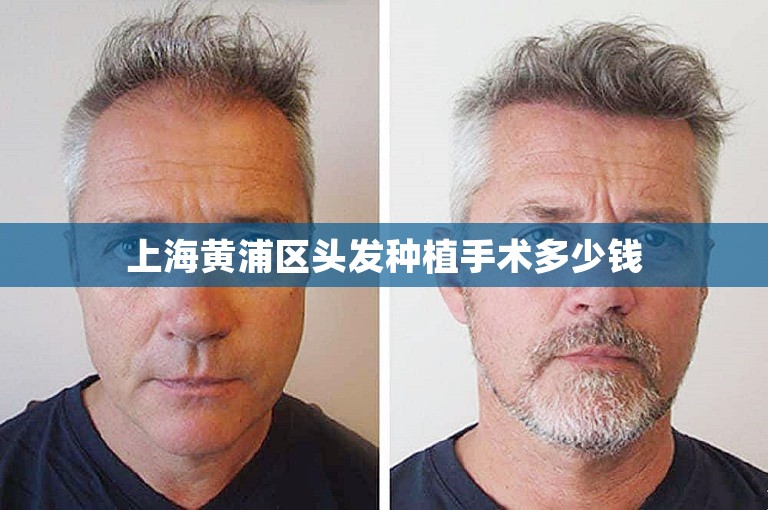 上海黄浦区头发种植手术多少钱
