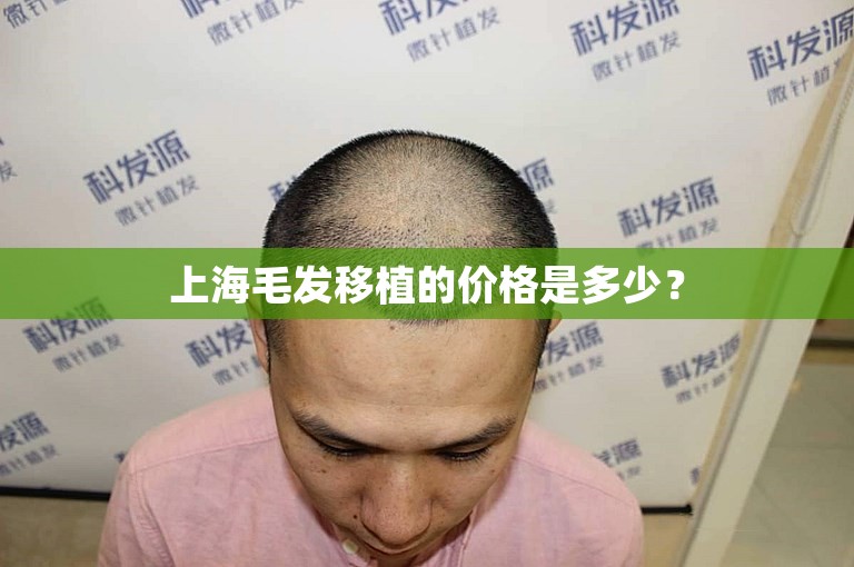 上海毛发移植的价格是多少？