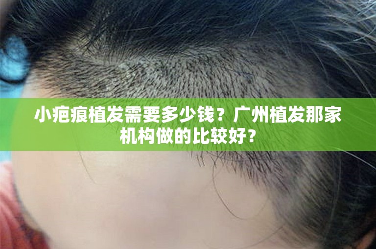 小疤痕植发需要多少钱？广州植发那家机构做的比较好？