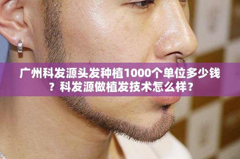 广州科发源头发种植1000个单位多少钱？科发源做植发技术怎么样？
