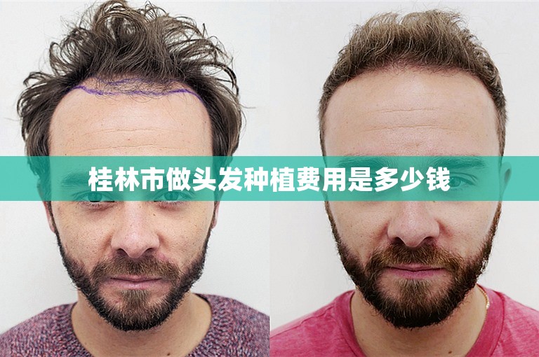 桂林市做头发种植费用是多少钱