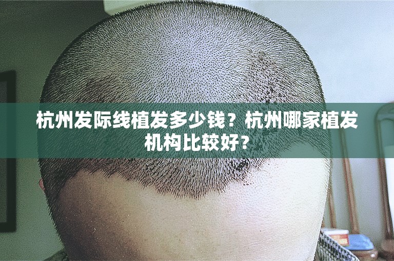 杭州发际线植发多少钱？杭州哪家植发机构比较好？