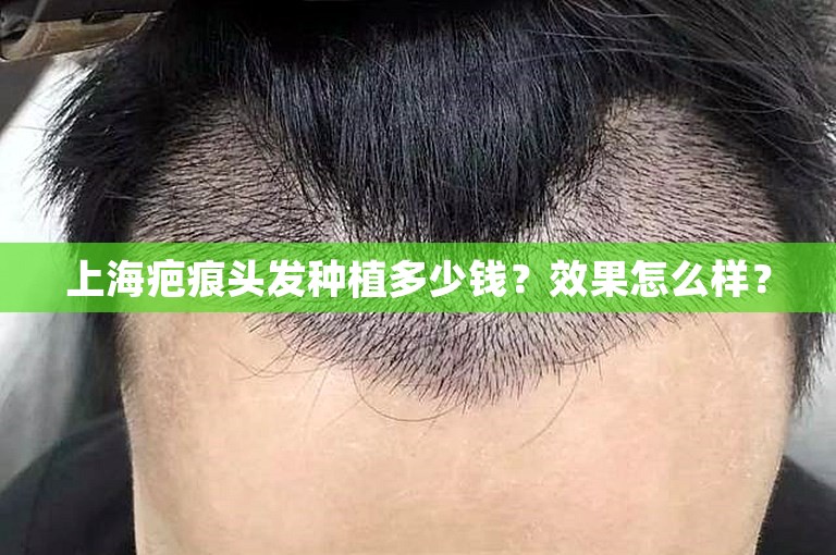 上海疤痕头发种植多少钱？效果怎么样？