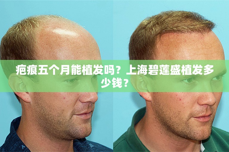 疤痕五个月能植发吗？上海碧莲盛植发多少钱？