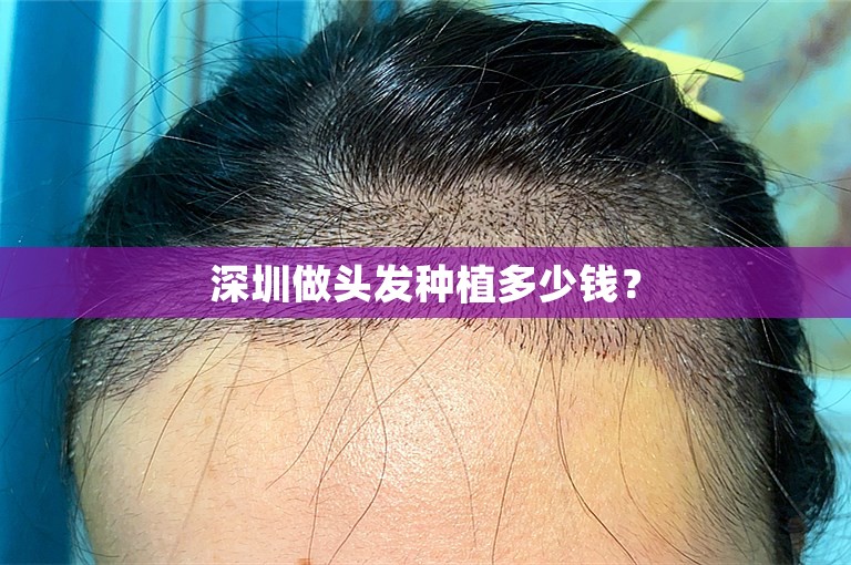 深圳做头发种植多少钱？