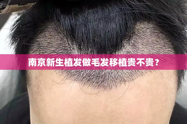 南京新生植发做毛发移植贵不贵？
