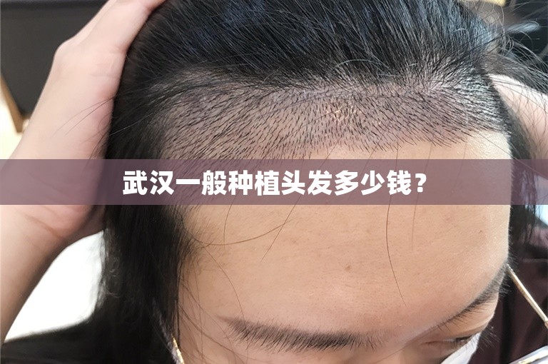 武汉一般种植头发多少钱？