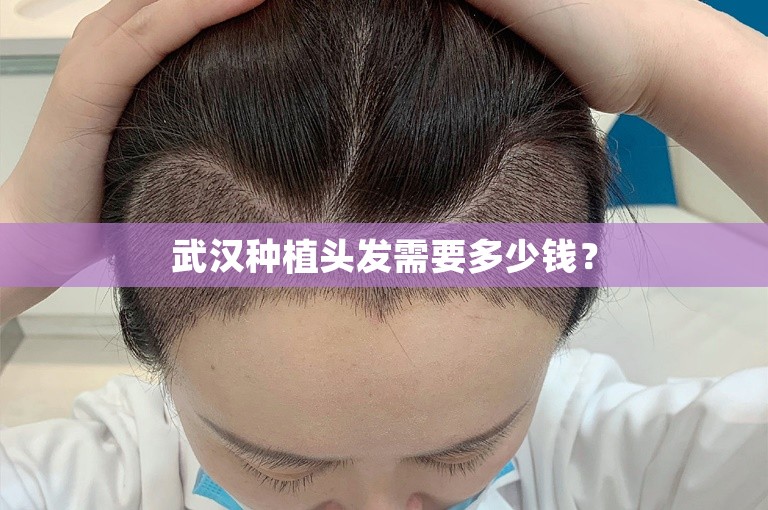武汉种植头发需要多少钱？