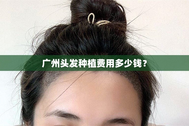 广州头发种植费用多少钱？