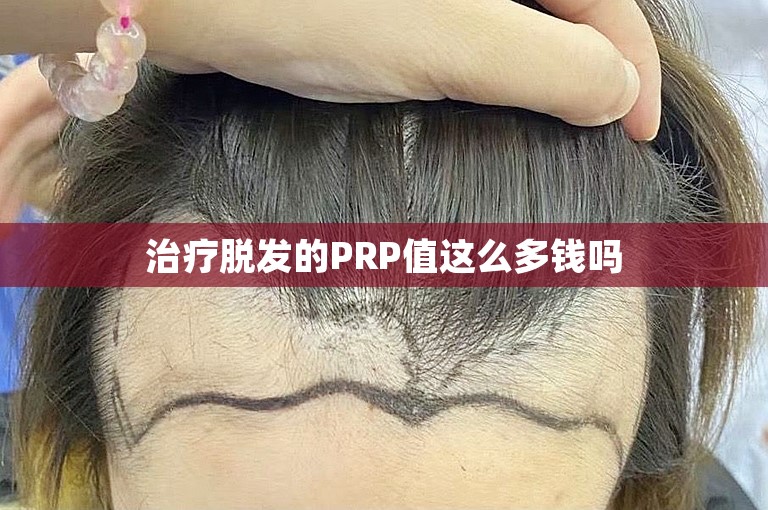 治疗脱发的PRP值这么多钱吗