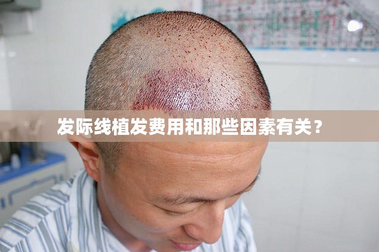 发际线植发费用和那些因素有关? 发际线植发费用和那些因素有关?