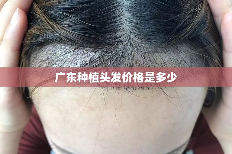 广东种植头发价格是多少