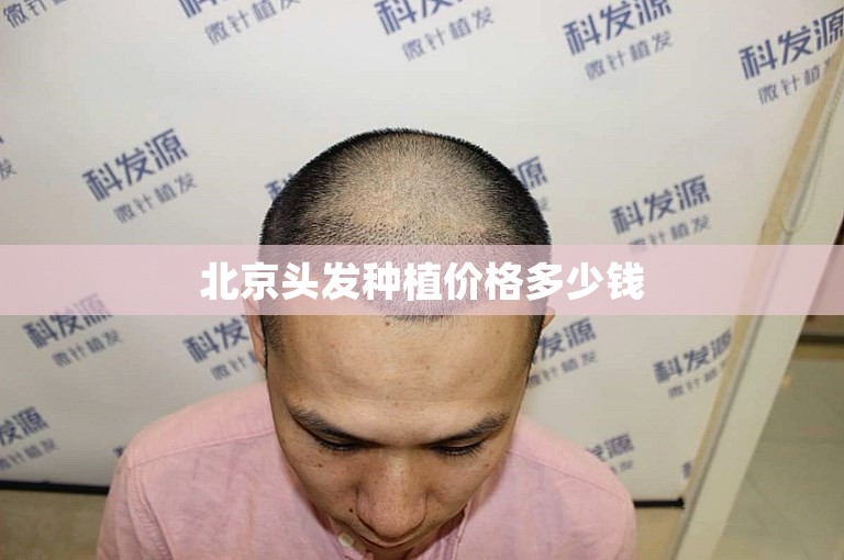 北京头发种植价格多少钱