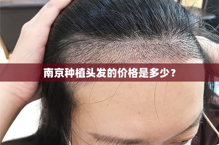 南京种植头发的价格是多少？