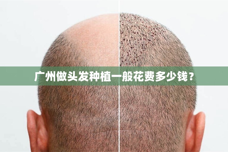 广州做头发种植一般花费多少钱？