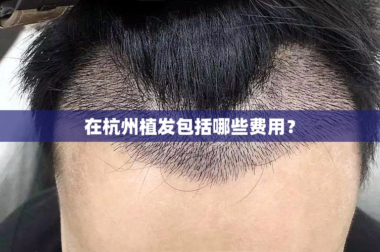 在杭州植发包括哪些费用？