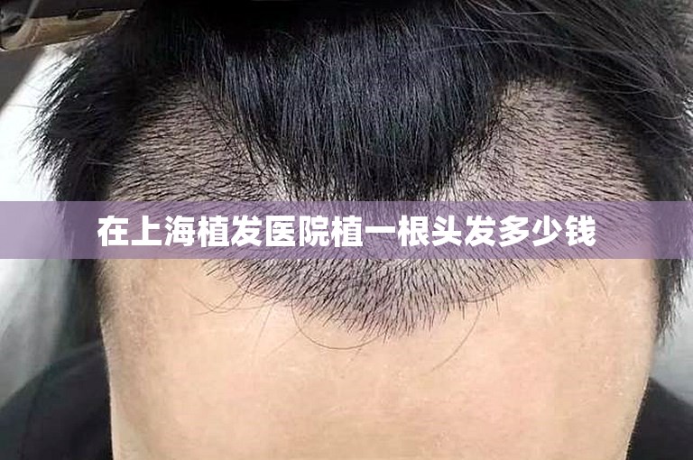 在上海植发医院植一根头发多少钱