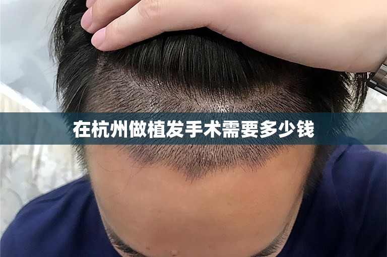 在杭州做植发手术需要多少钱