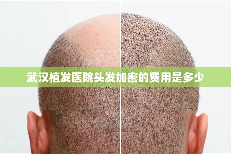 武汉植发医院头发加密的费用是多少