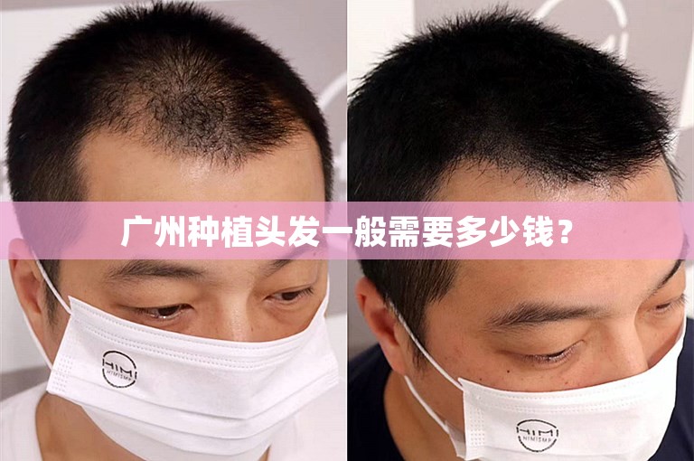 广州种植头发一般需要多少钱？