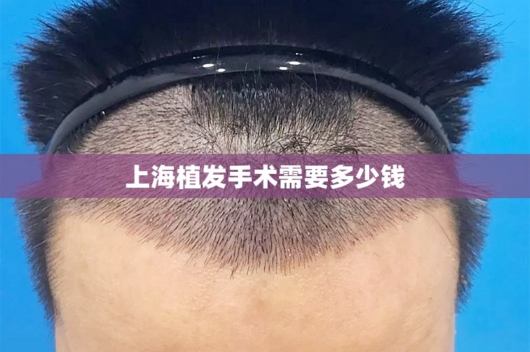上海植发手术需要多少钱