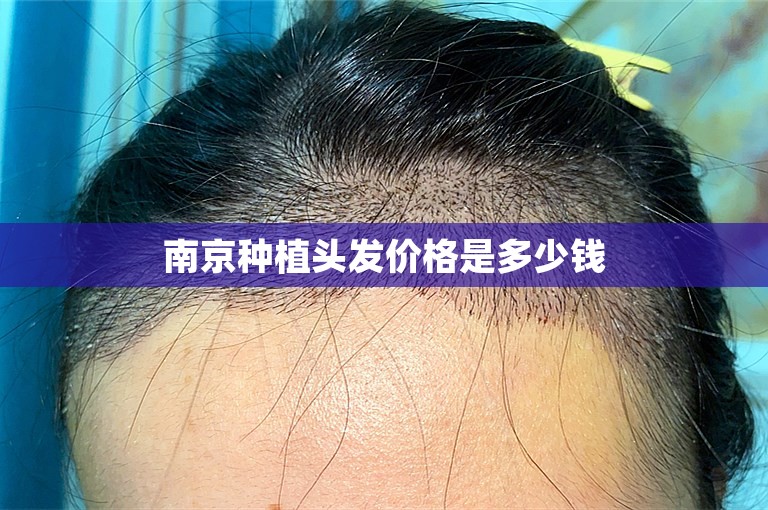 南京种植头发价格是多少钱