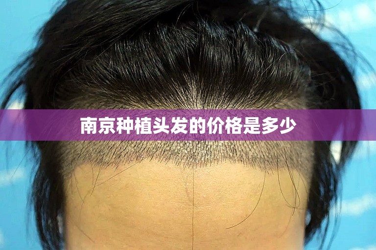 南京种植头发的价格是多少