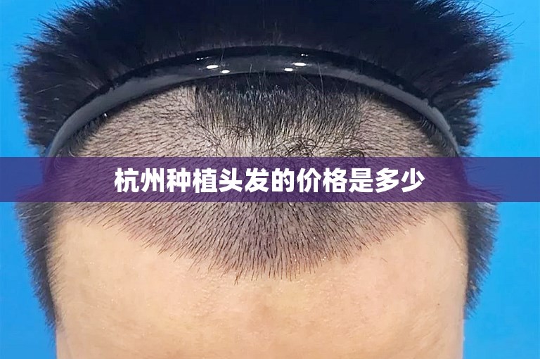 杭州种植头发的价格是多少