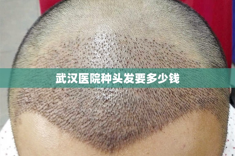 武汉医院种头发要多少钱